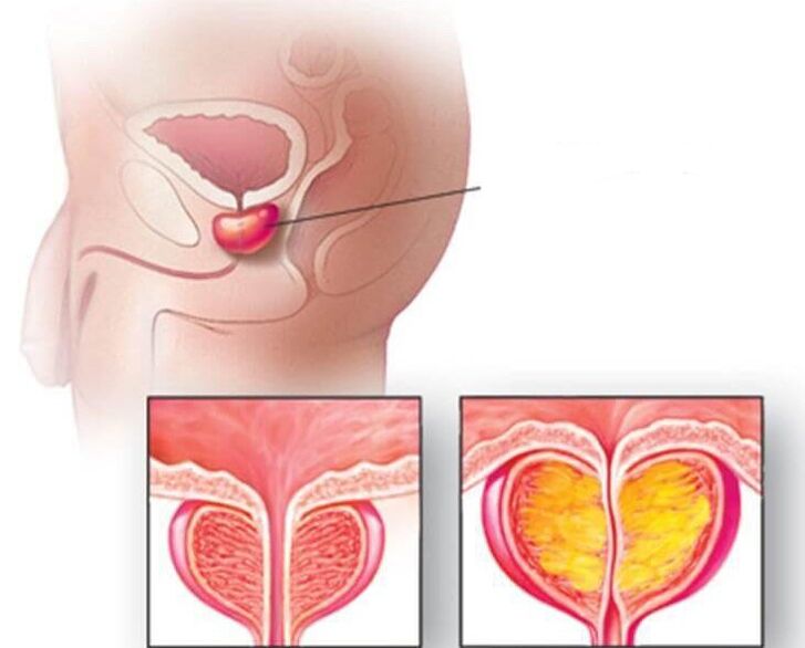 Lokacija prostate, normalna prostata i povećana kod kroničnog prostatitisa