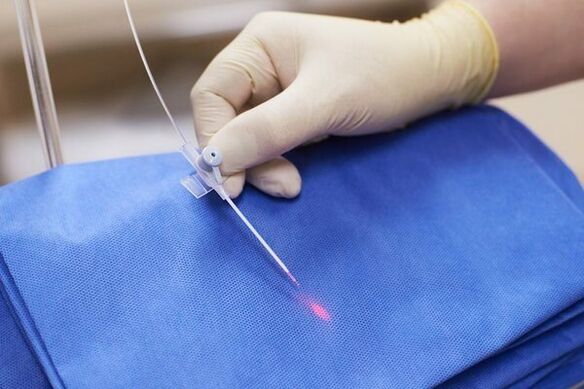 U nekim slučajevima, laserska terapija se koristi za kronični prostatitis