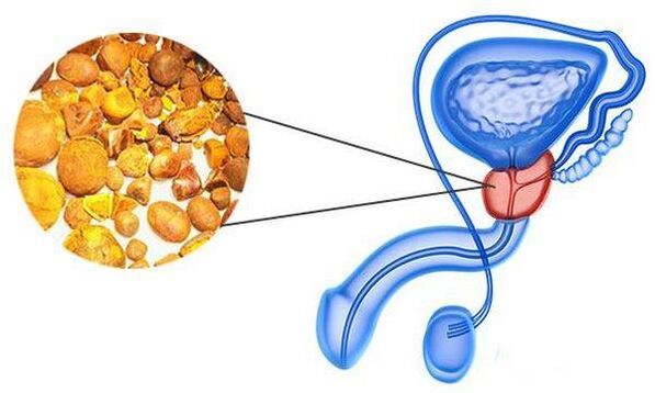 Problemi s prostatitisom