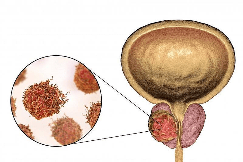 kako izgleda oštećenje prostate