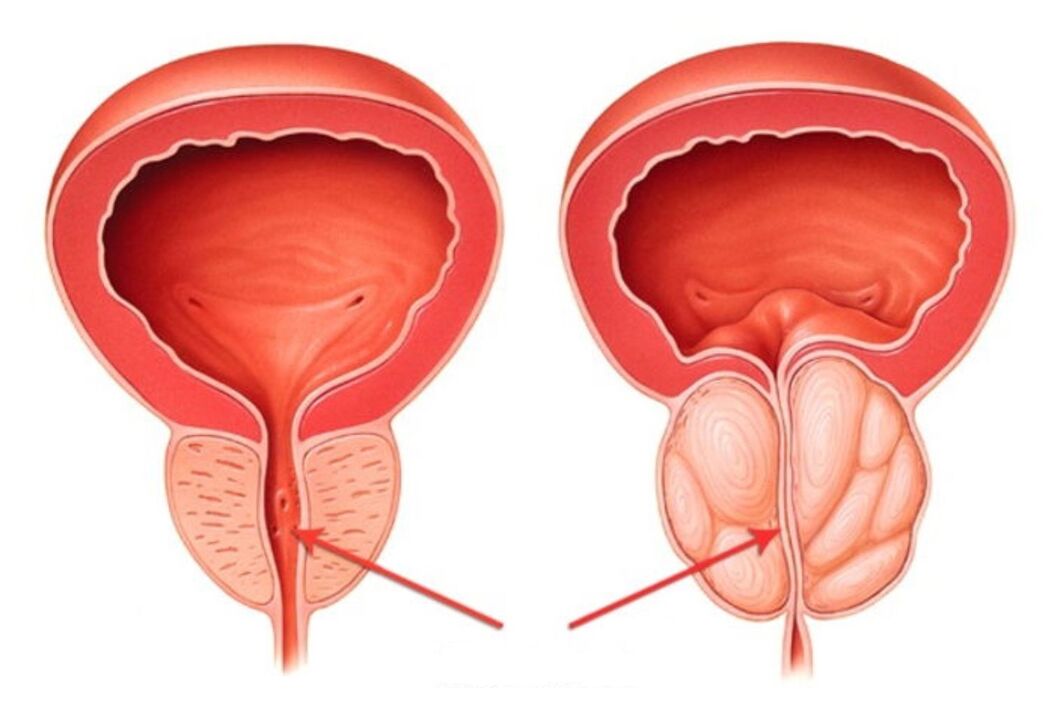 zdrava i upaljena prostata s prostatitisom